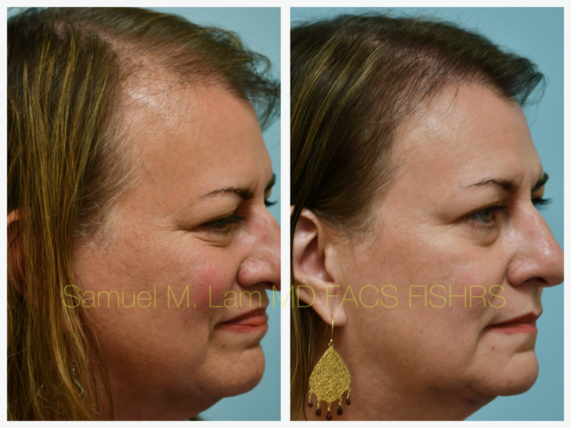 Hairline Lowering Before and After Photo by Dr. Lam in Plano, TX