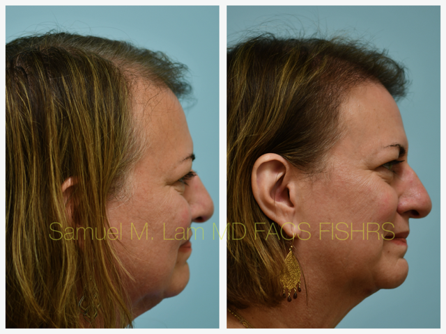 Hairline Lowering Before and After Photo by Dr. Lam in Plano, TX