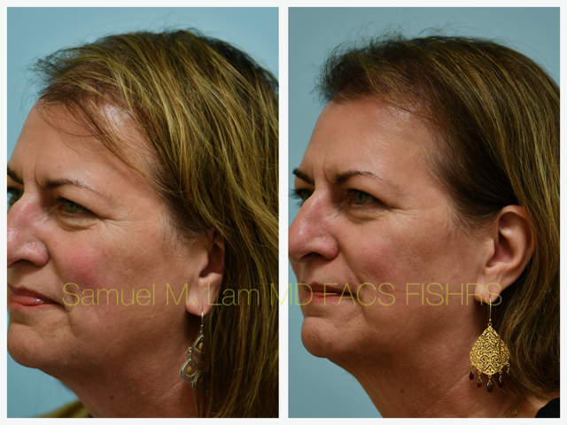 Hairline Lowering Before and After Photo by Dr. Lam in Plano, TX