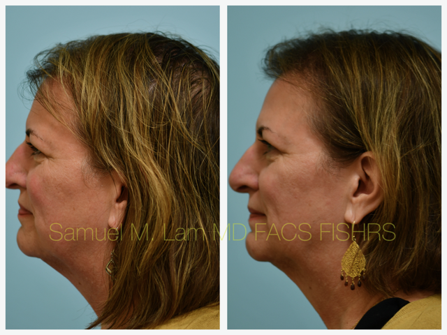 Hairline Lowering Before and After Photo by Dr. Lam in Plano, TX