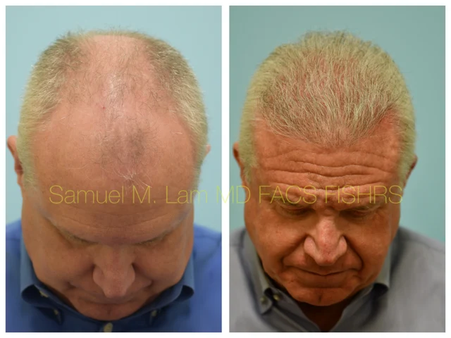 Hairline and Central Density Before and After Photo by Dr. Lam in Plano TX