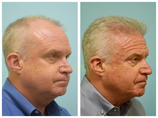 Hairline and Central Density Before and After Photo by Dr. Lam in Plano TX