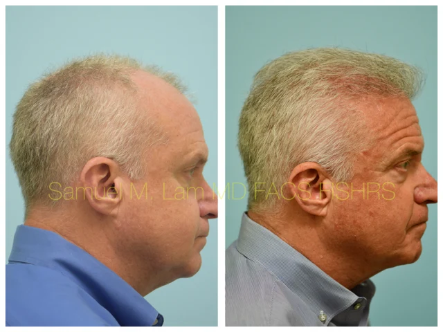 Hairline and Central Density Before and After Photo by Dr. Lam in Plano TX