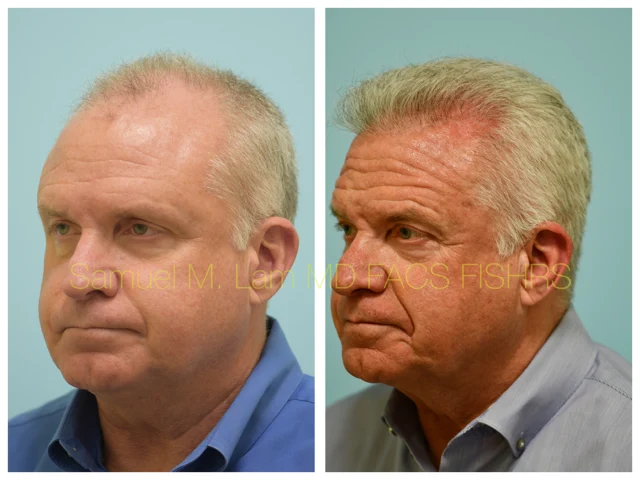 Hairline and Central Density Before and After Photo by Dr. Lam in Plano TX