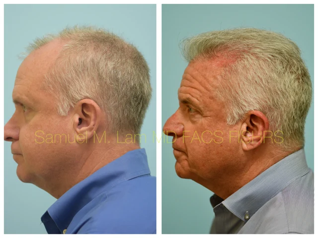 Hairline and Central Density Before and After Photo by Dr. Lam in Plano TX