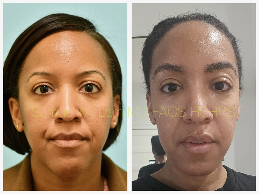 African Hair Transplant Before and After Photo by Dr. Lam in Plano TX