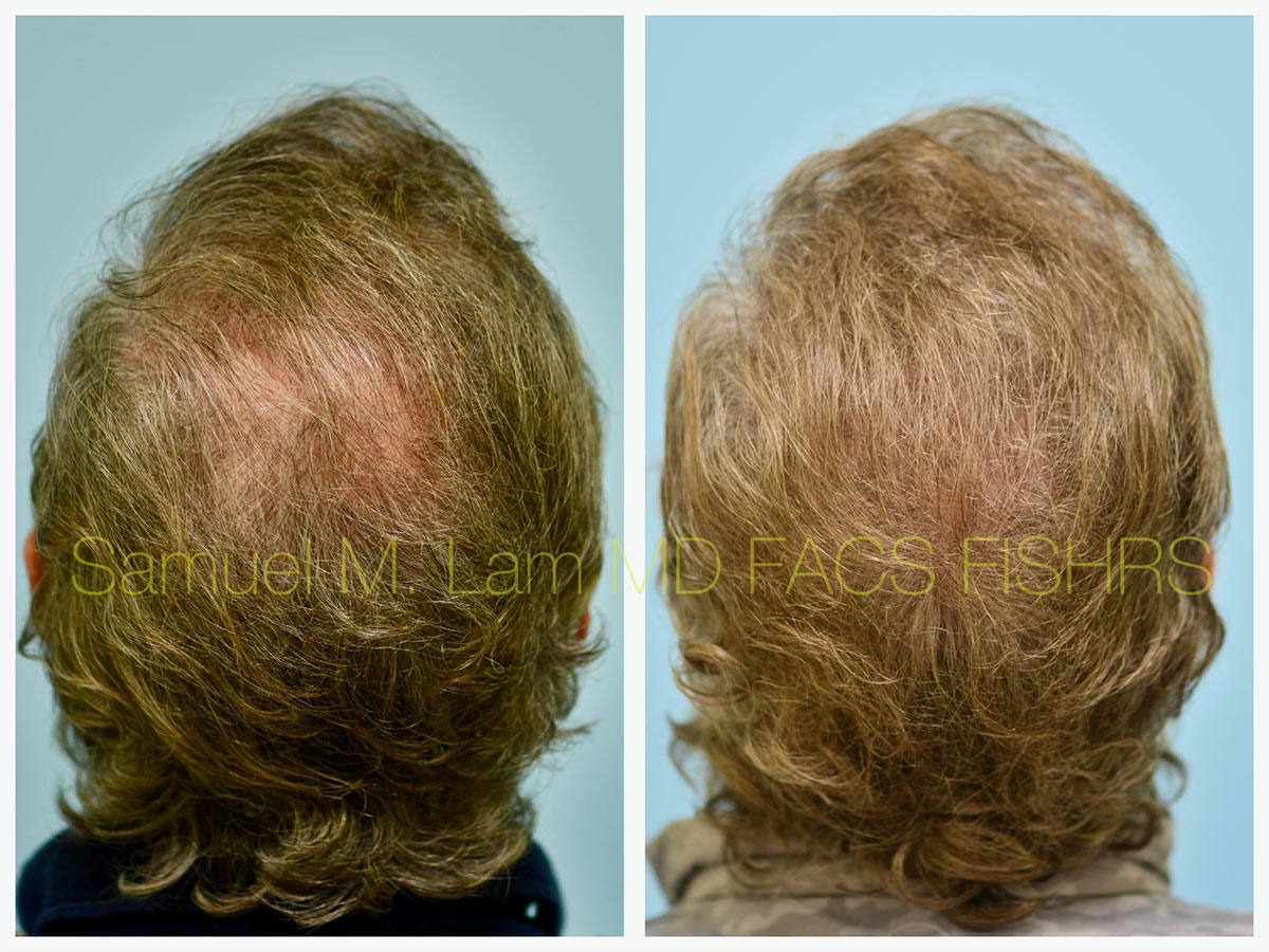 Crown Hair Transplant Before and After Photo by Dr. Lam in Plano, TX