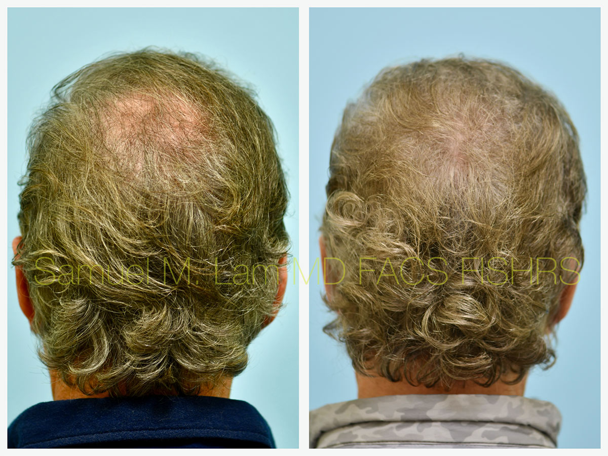 Crown Hair Transplant Before and After Photo by Dr. Lam in Plano, TX