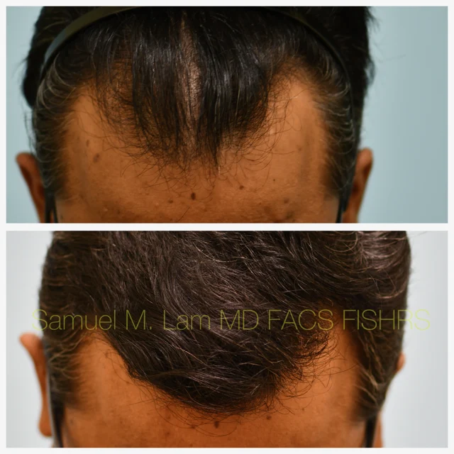 Finasteride and Minoxidil Before and After Photo by Dr. Lam in Plano TX