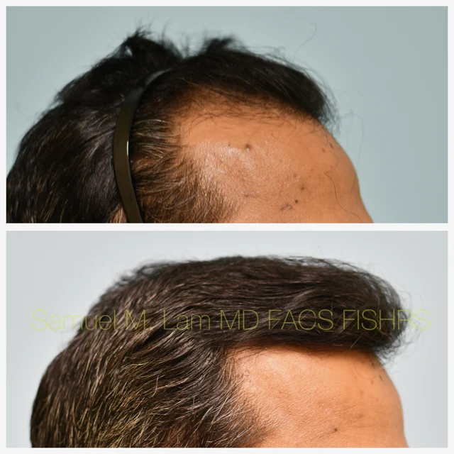Finasteride and Minoxidil Before and After Photo by Dr. Lam in Plano TX