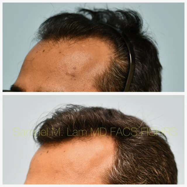 Finasteride and Minoxidil Before and After Photo by Dr. Lam in Plano TX