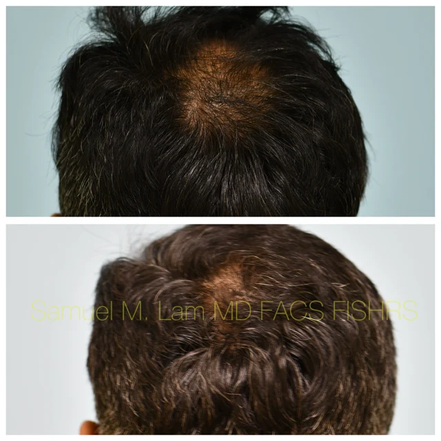 Finasteride and Minoxidil Before and After Photo by Dr. Lam in Plano TX