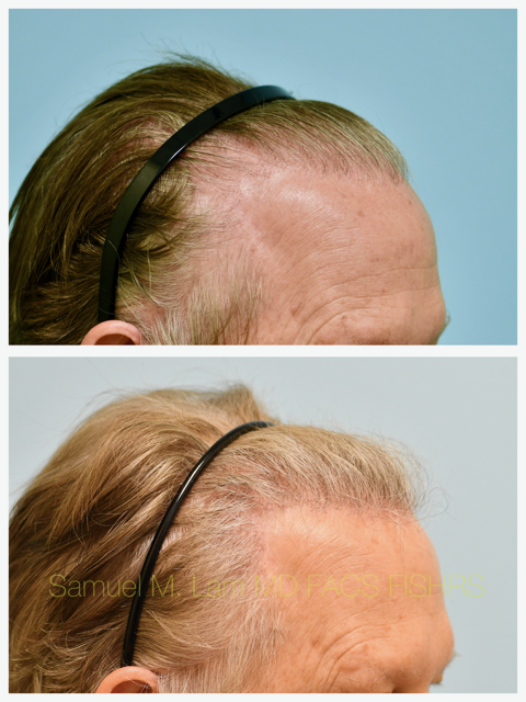 Hair Transplant Before and After Photo by Dr. Lam in Plano, TX