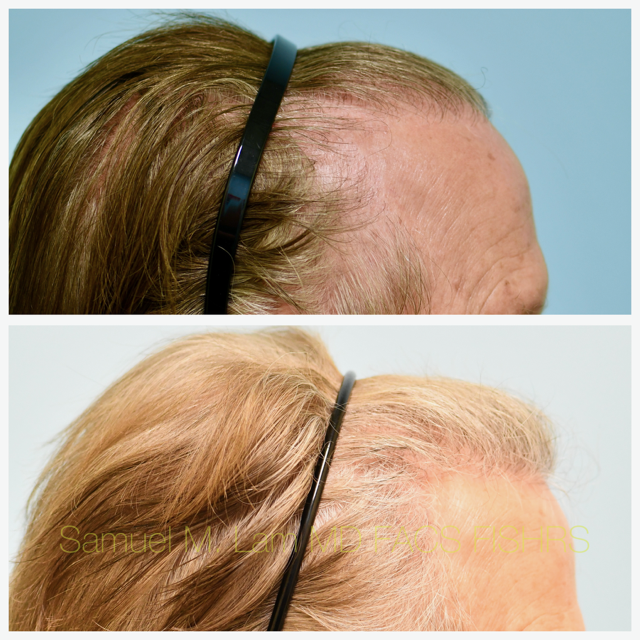 Hair Transplant Before and After Photo by Dr. Lam in Plano, TX