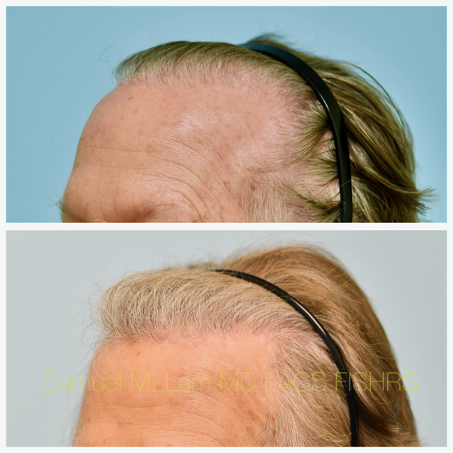 Hair Transplant Before and After Photo by Dr. Lam in Plano, TX