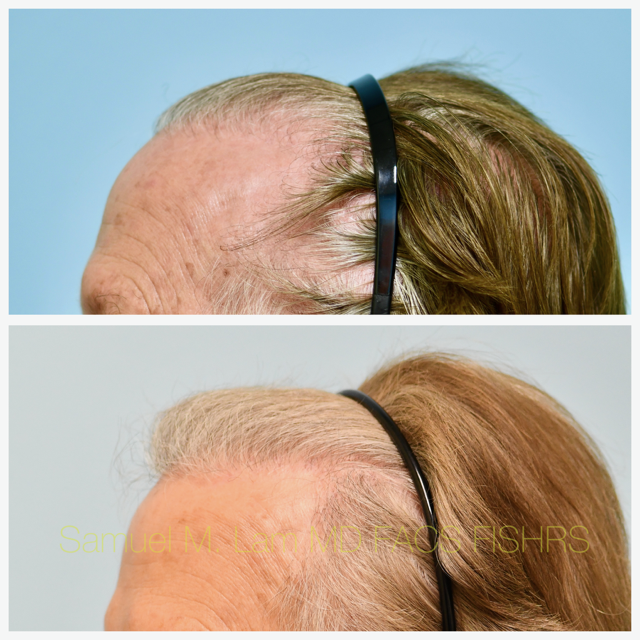 Hair Transplant Before and After Photo by Dr. Lam in Plano, TX