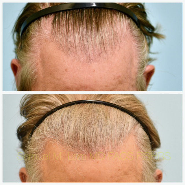 Hair Transplant Before and After Photo by Dr. Lam in Plano, TX