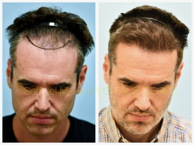 Hairline and Central Density Before and After Photo by Dr. Lam in Plano, TX