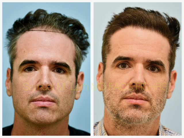 Hairline and Central Density Before and After Photo by Dr. Lam in Plano, TX