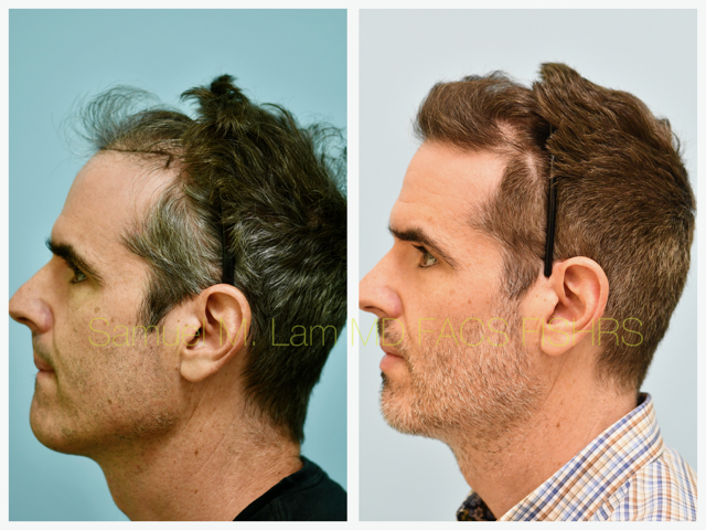 Hairline and Central Density Before and After Photo by Dr. Lam in Plano, TX