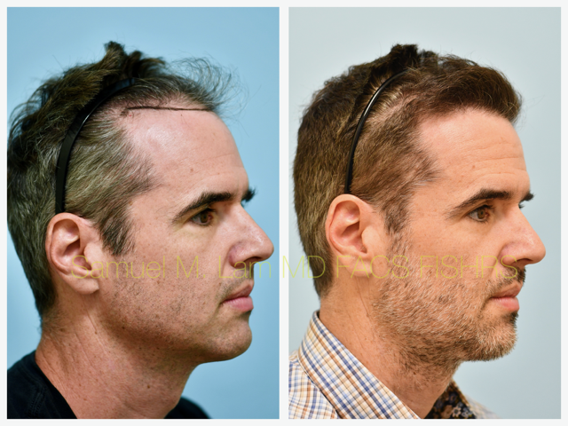 Hairline and Central Density Before and After Photo by Dr. Lam in Plano, TX