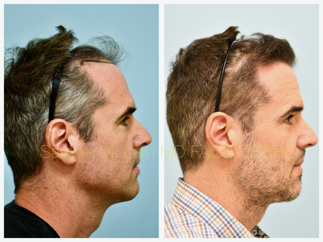 Hairline and Central Density Before and After Photo by Dr. Lam in Plano, TX