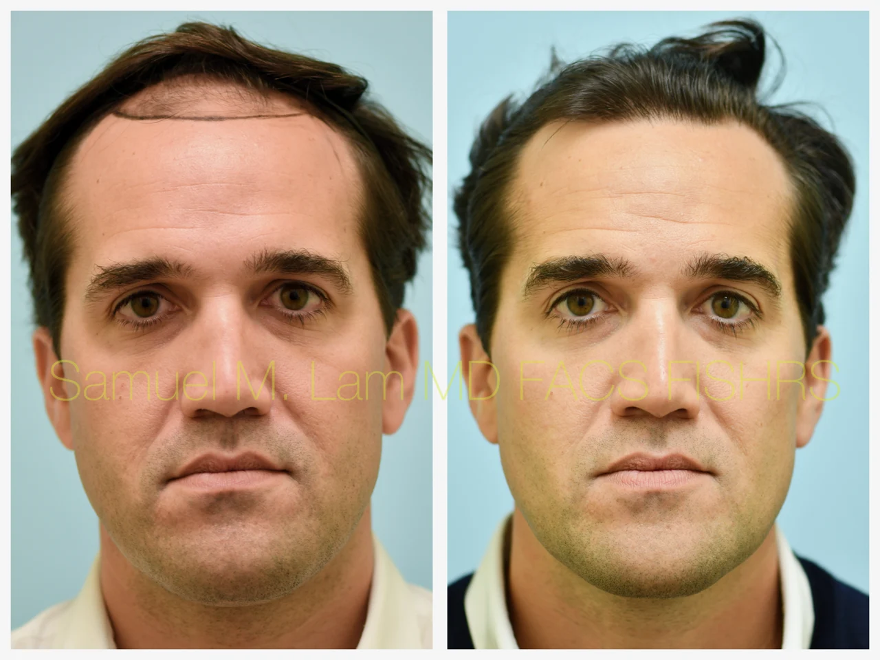 Hairline/Central Density Before and After Photo by Dr. Lam in Plano TX