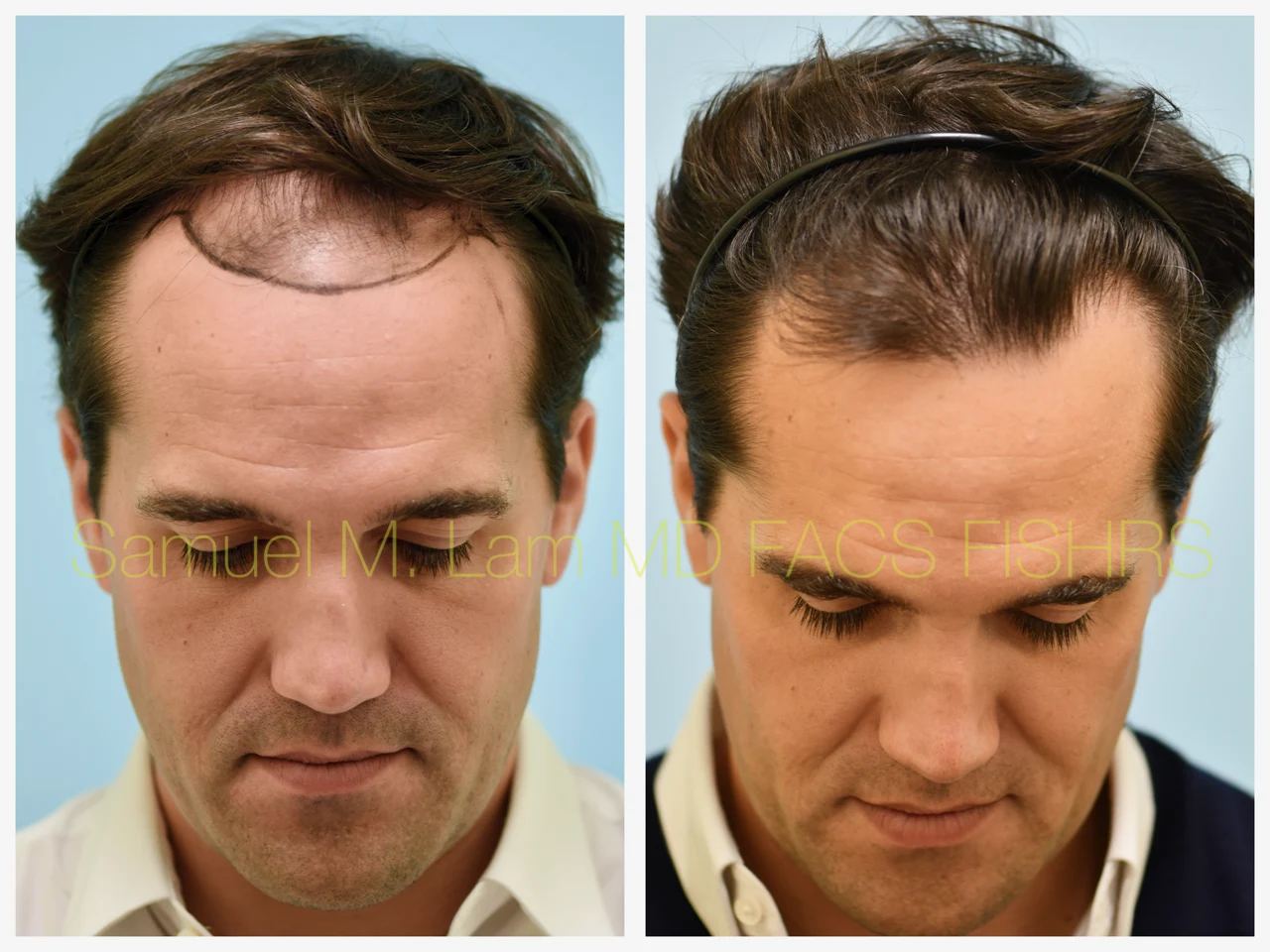 Hairline/Central Density Before and After Photo by Dr. Lam in Plano TX