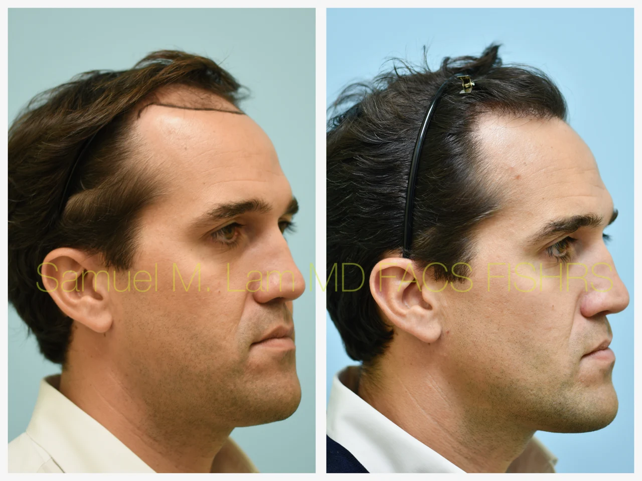Hairline/Central Density Before and After Photo by Dr. Lam in Plano TX