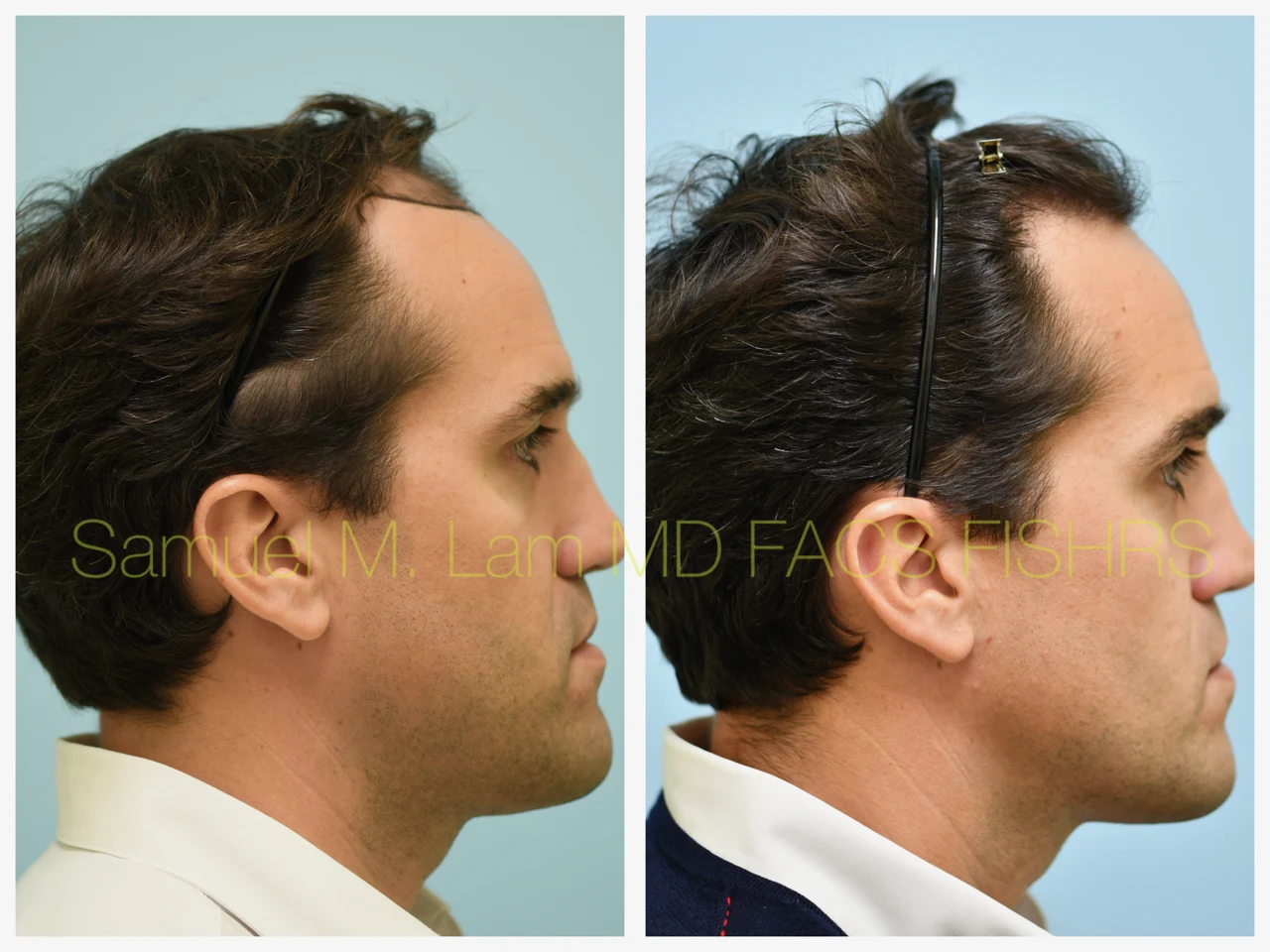 Hairline/Central Density Before and After Photo by Dr. Lam in Plano TX