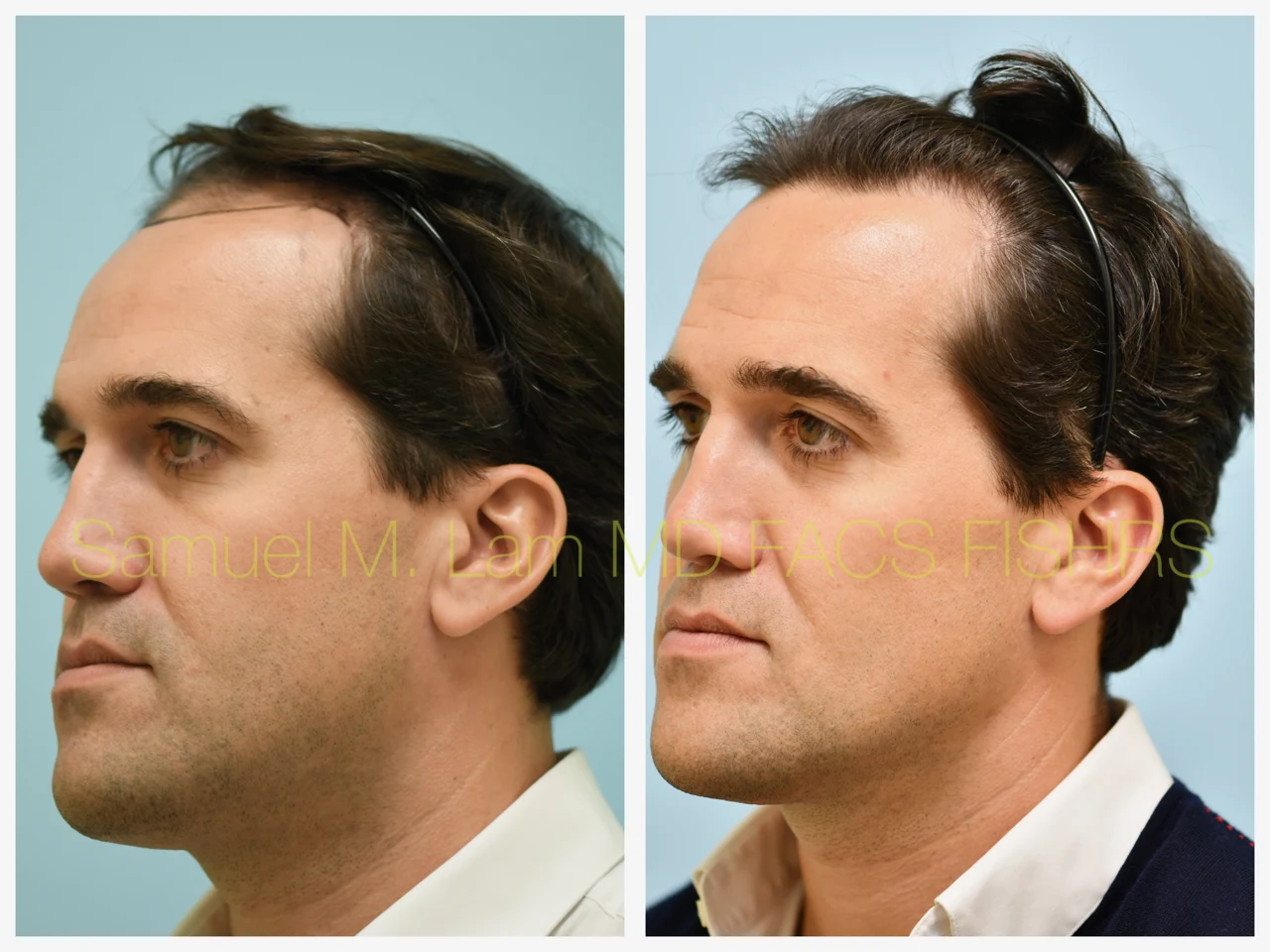 Hairline/Central Density Before and After Photo by Dr. Lam in Plano TX