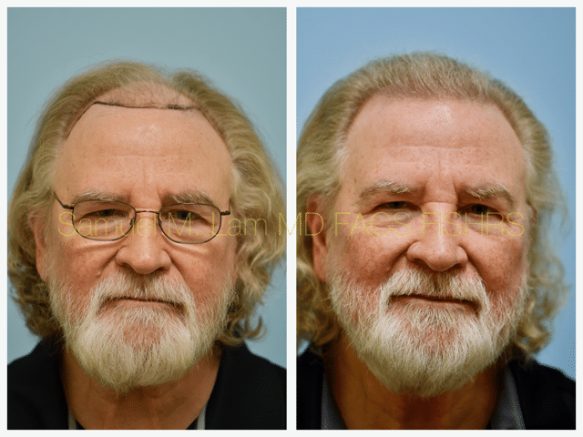 Hairline and Central Density Before and After Photo by Dr. Lam in Plano, TX