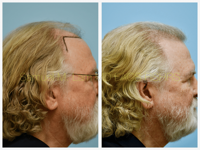 Hairline and Central Density Before and After Photo by Dr. Lam in Plano, TX