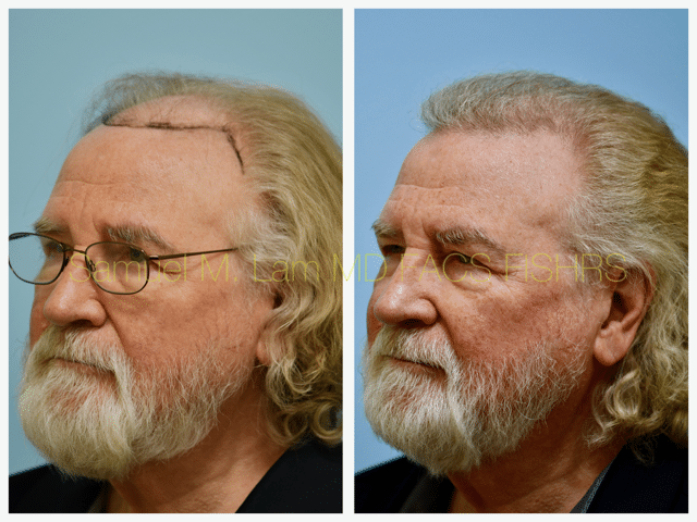 Hairline and Central Density Before and After Photo by Dr. Lam in Plano, TX