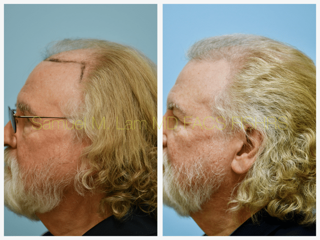 Hairline and Central Density Before and After Photo by Dr. Lam in Plano, TX