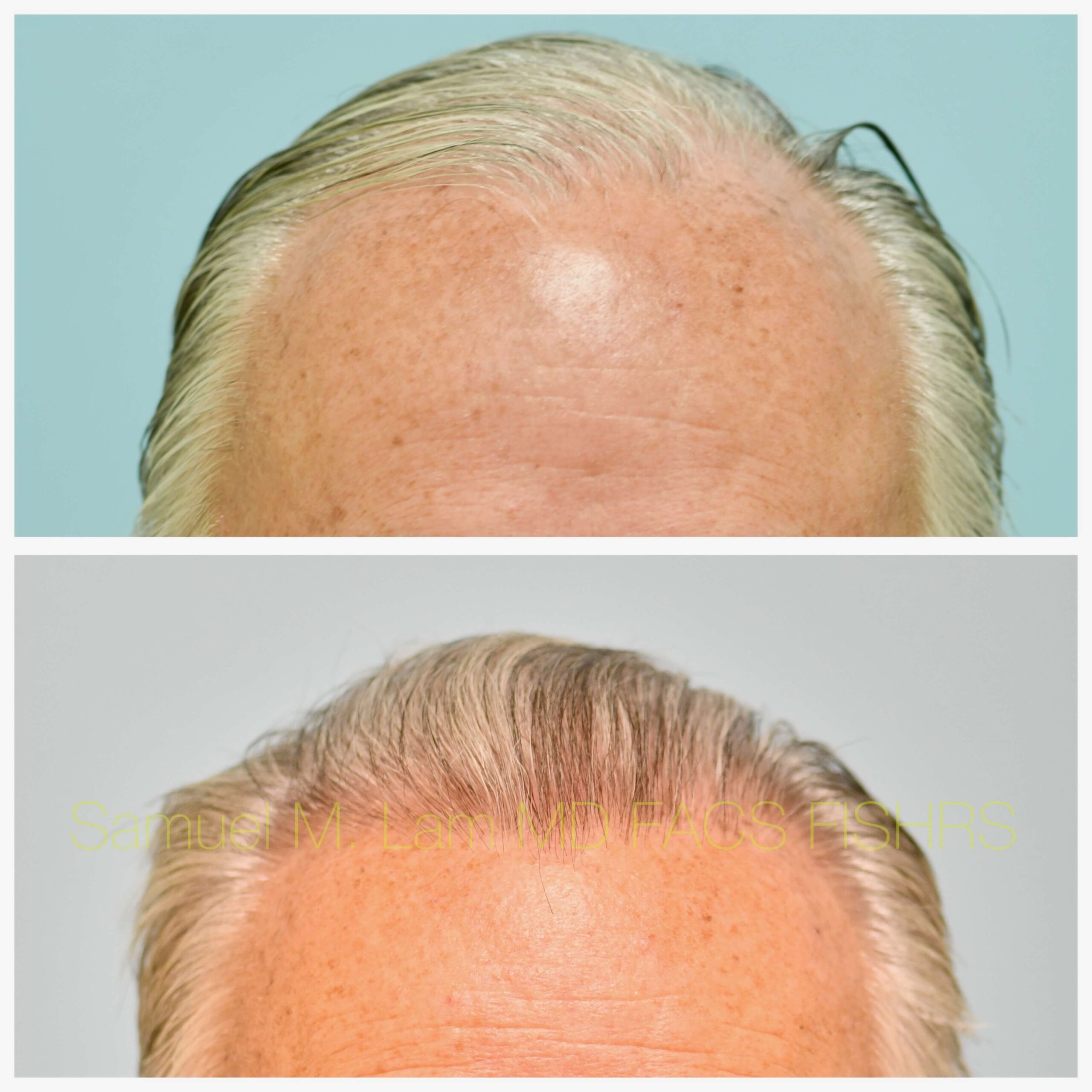 Hairline and Central Density Before and After Photo by Dr. Lam in Plano TX