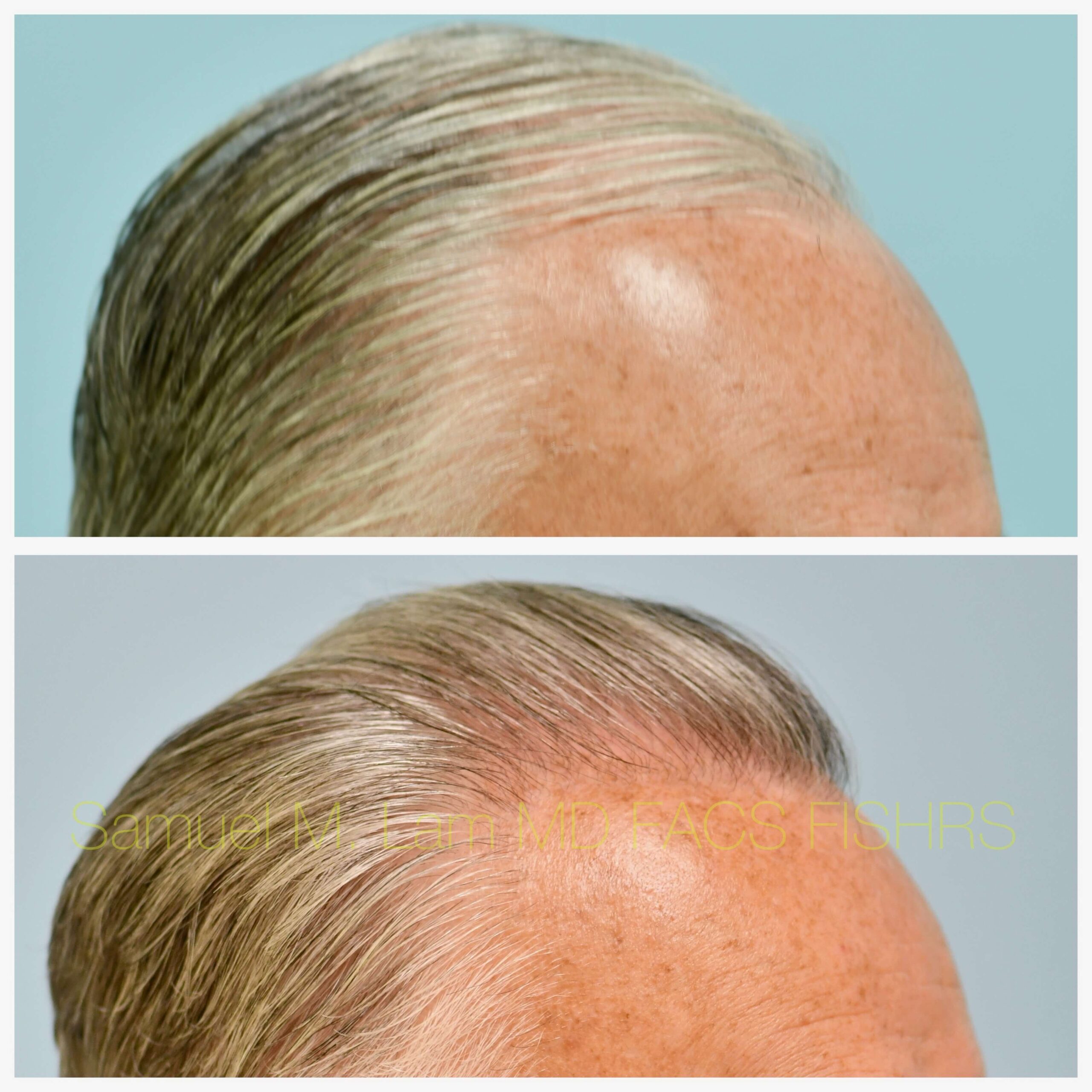 Hairline and Central Density Before and After Photo by Dr. Lam in Plano TX