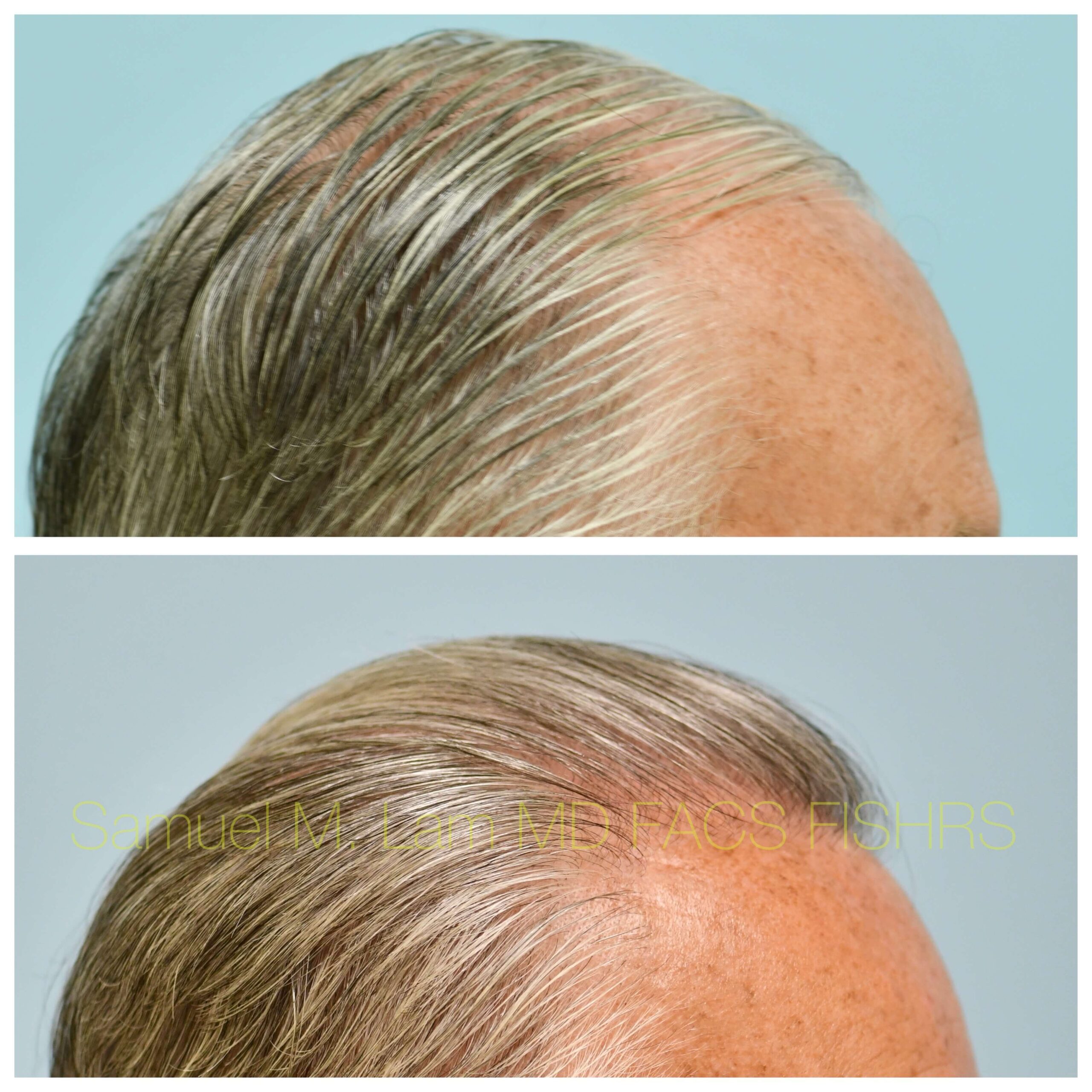 Hairline and Central Density Before and After Photo by Dr. Lam in Plano TX