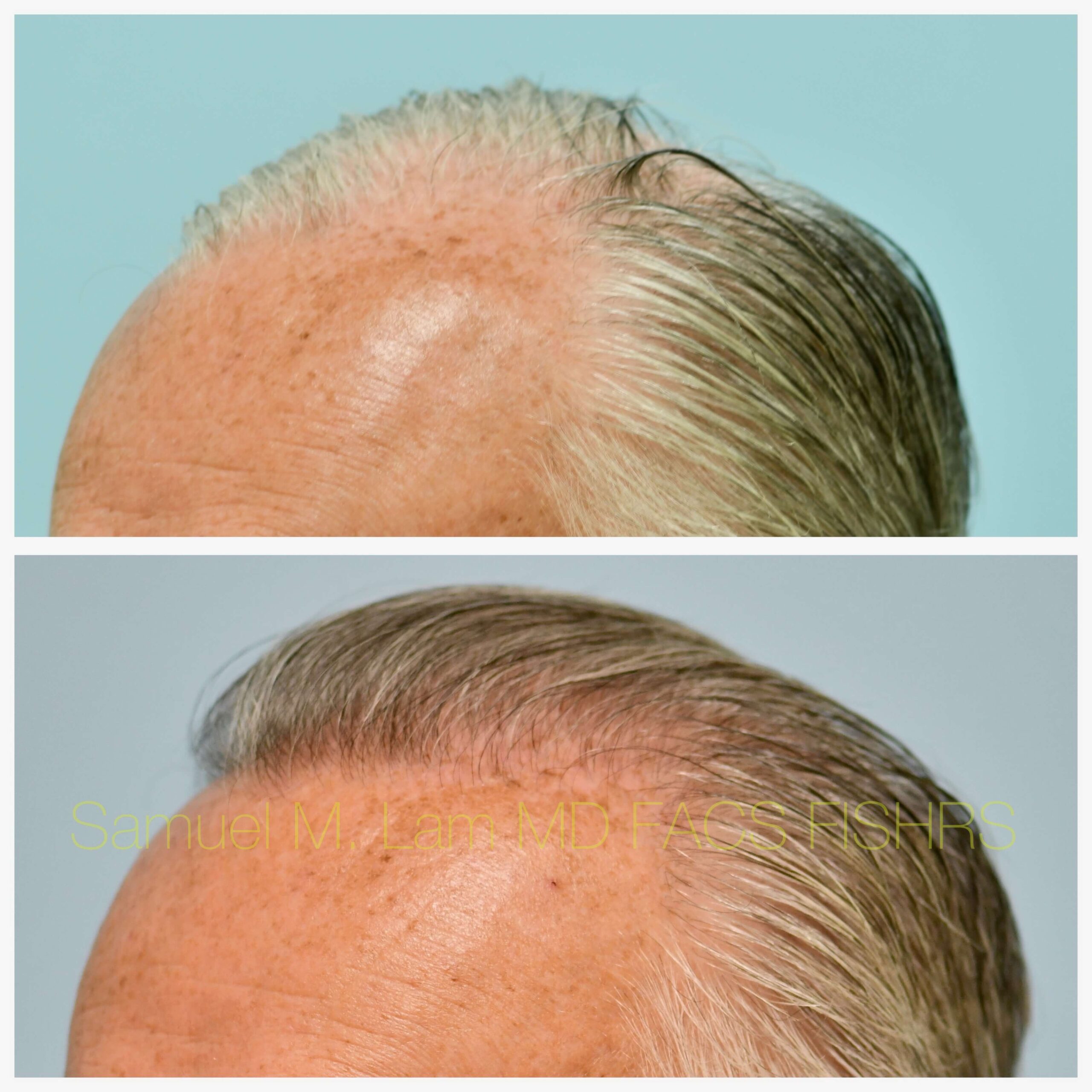 Hairline and Central Density Before and After Photo by Dr. Lam in Plano TX