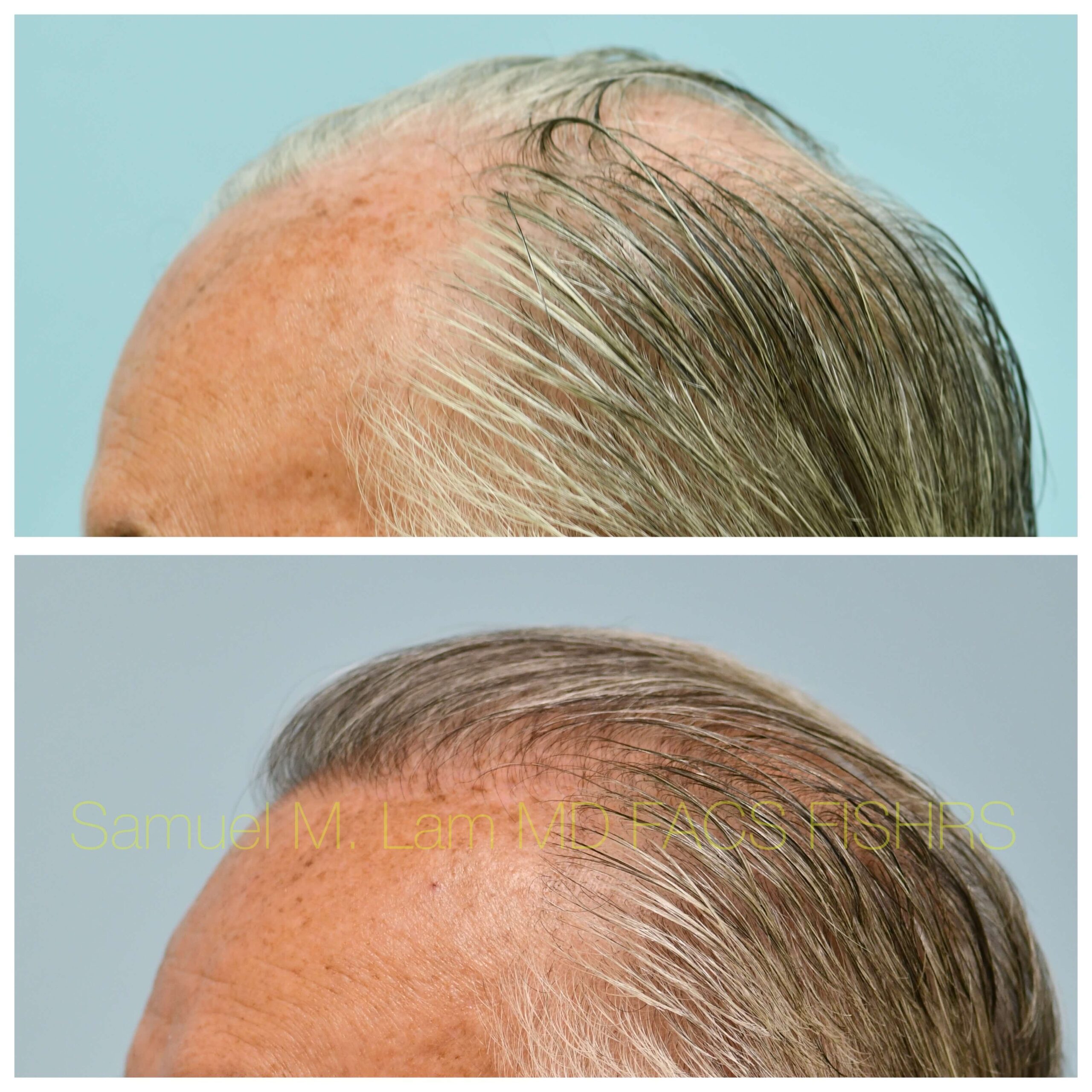 Hairline and Central Density Before and After Photo by Dr. Lam in Plano TX