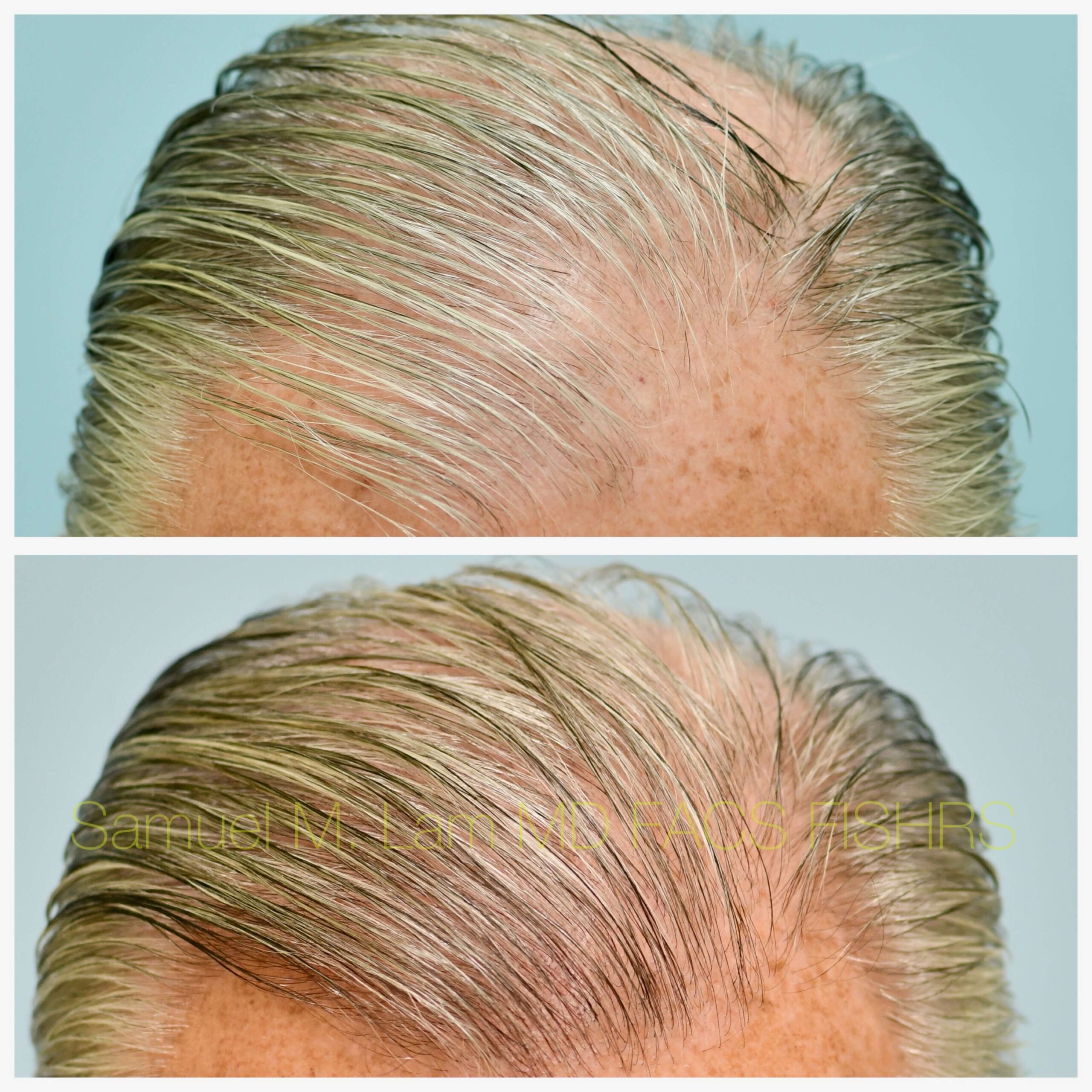 Hairline and Central Density Before and After Photo by Dr. Lam in Plano TX