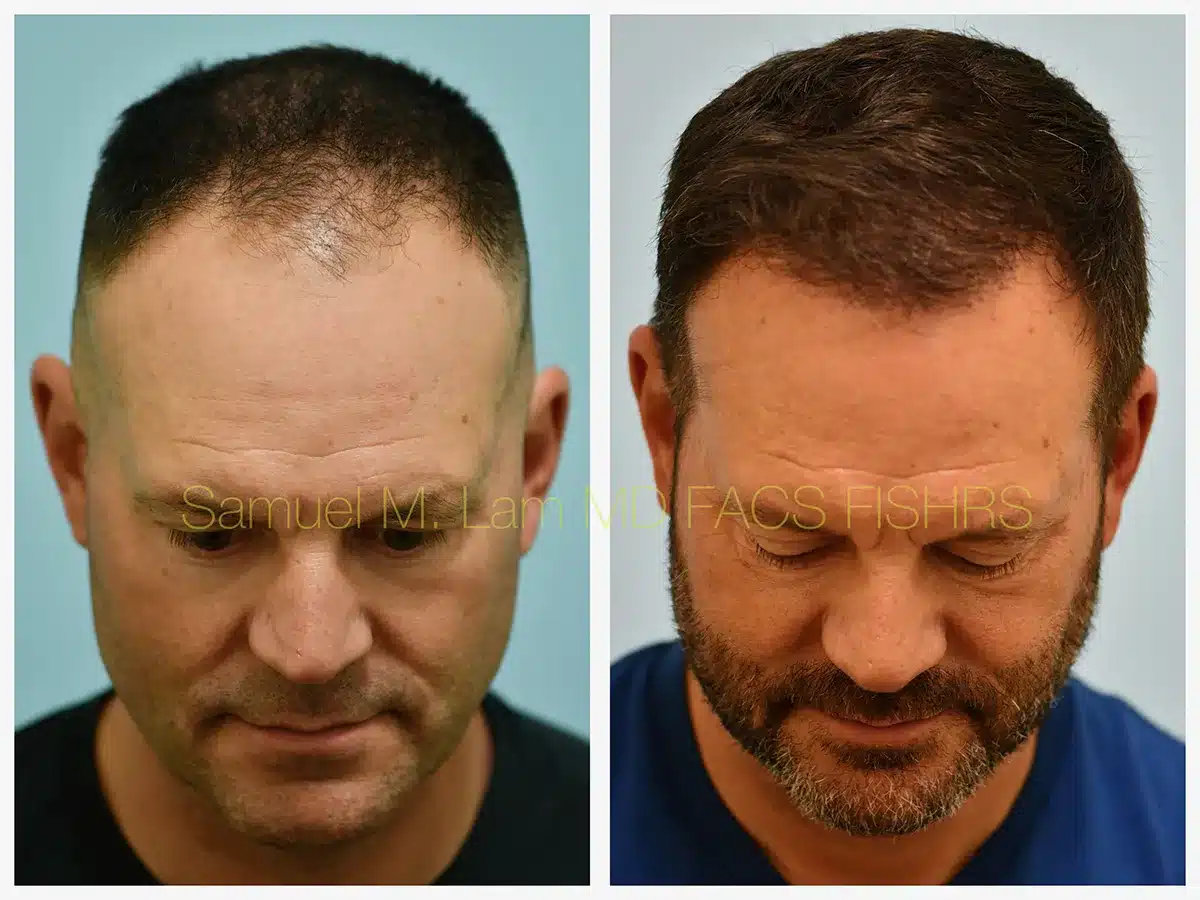 Hairline and Central Density Before and After Photo by Dr. Lam in Plano, TX