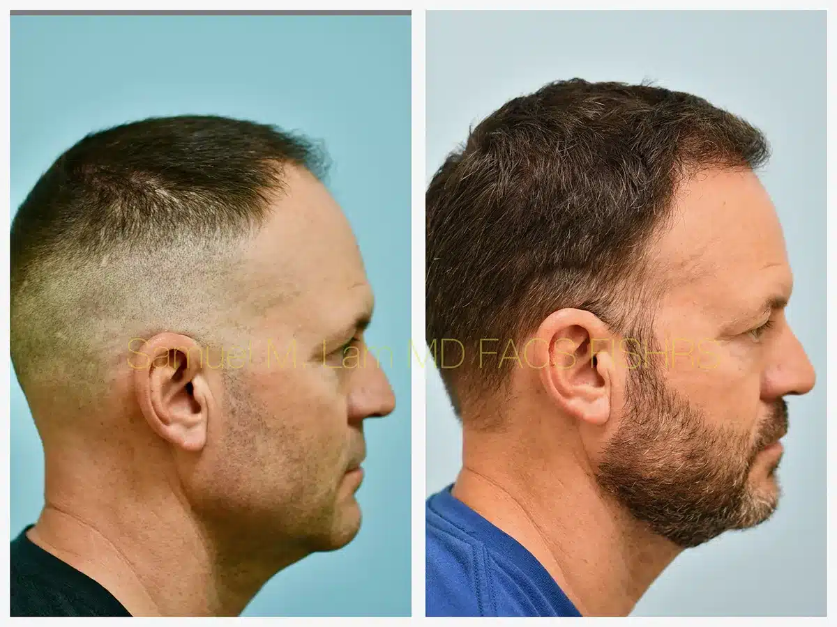Hairline and Central Density Before and After Photo by Dr. Lam in Plano, TX