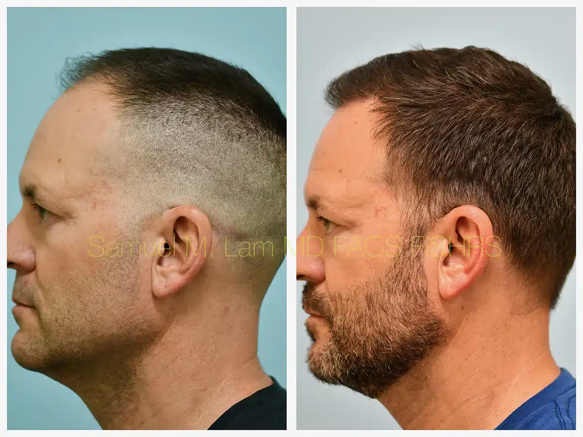 Hairline and Central Density Before and After Photo by Dr. Lam in Plano, TX