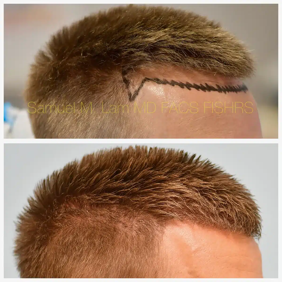 Hairline and central density Before and After Photo by Dr. Lam in Plano, TX