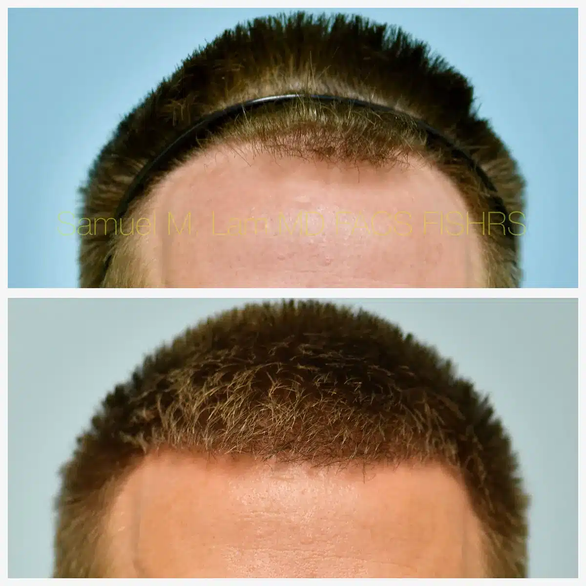 Hairline and central density Before and After Photo by Dr. Lam in Plano, TX