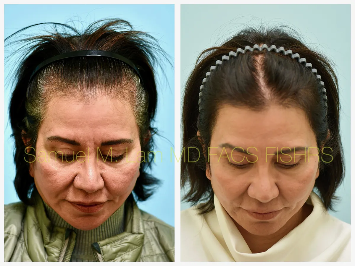 Hair Restoration Before and After Photo by Dr. Lam in Plano, TX