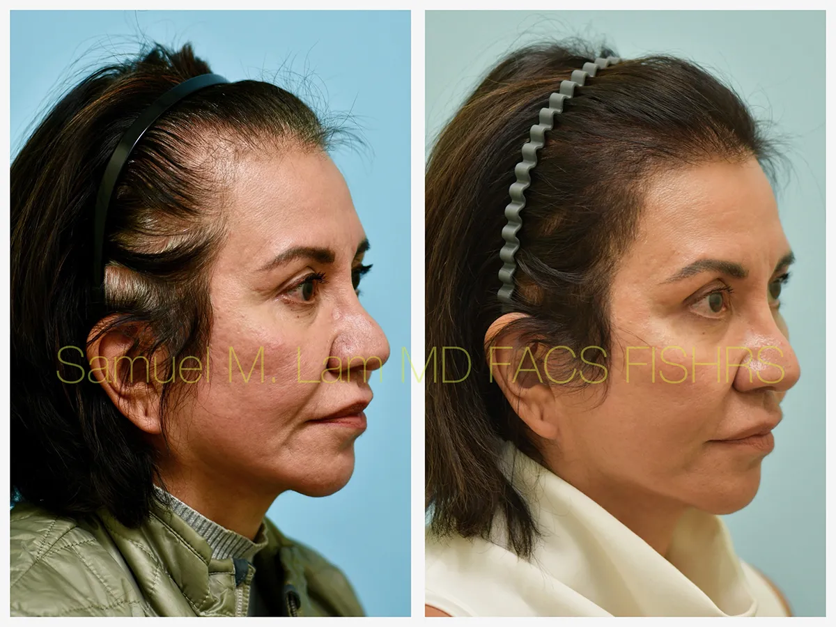 Hair Restoration Before and After Photo by Dr. Lam in Plano, TX