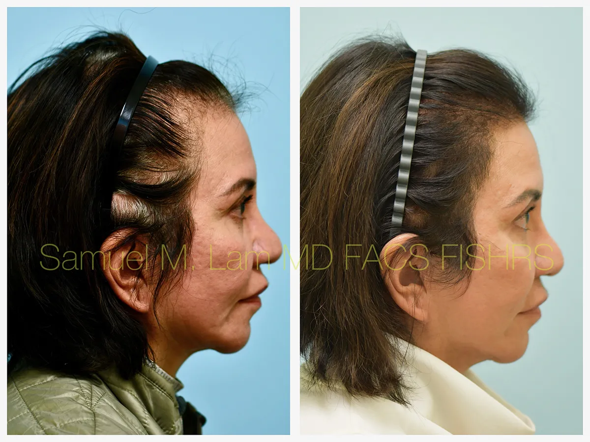 Hair Restoration Before and After Photo by Dr. Lam in Plano, TX