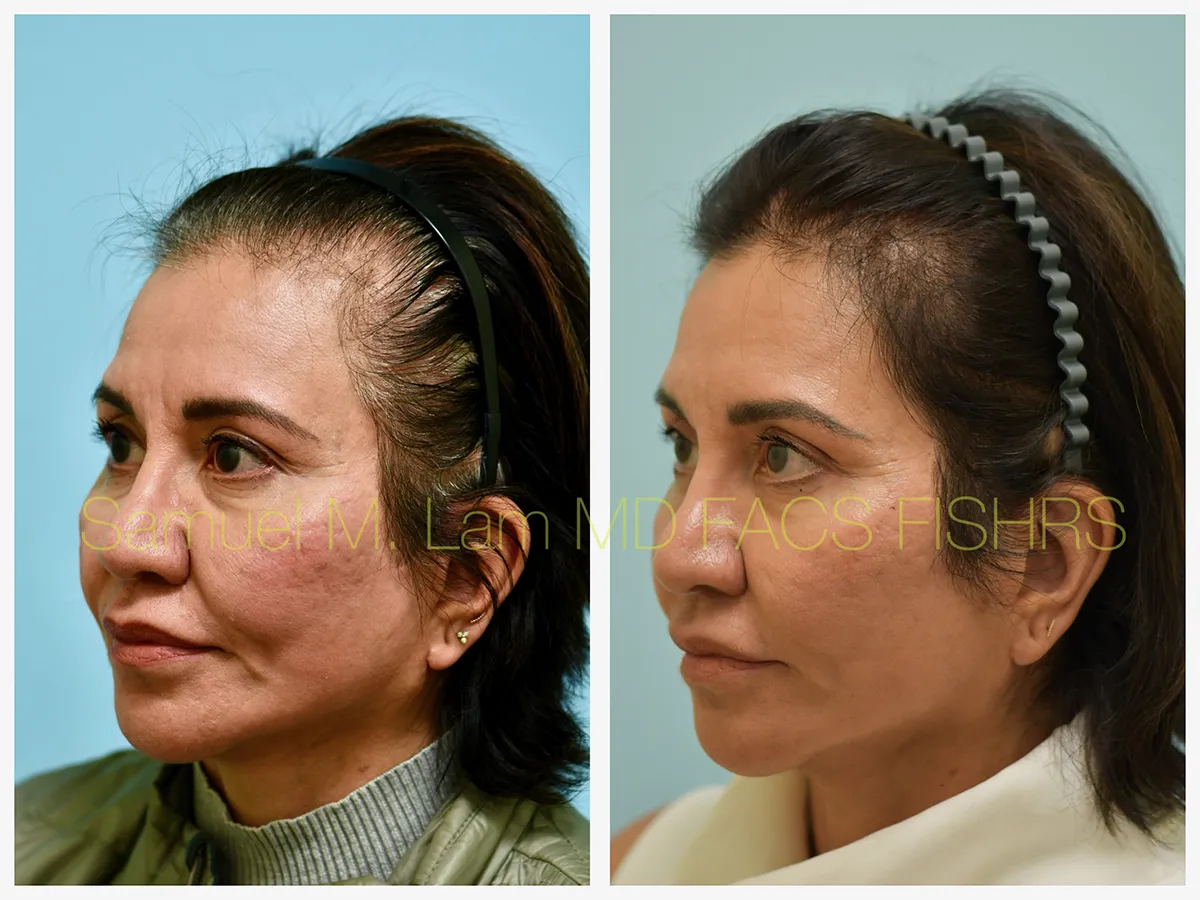 Hair Restoration Before and After Photo by Dr. Lam in Plano, TX
